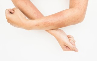 蛇缠腰疱疹怎么治疗好得快？别信偏方用这招【蛇缠腰疱疹怎么治疗好得快能洗澡吗】